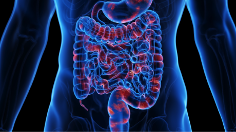 Crohn