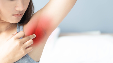 Hidradenitis spprativa